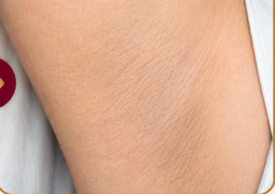 Depois