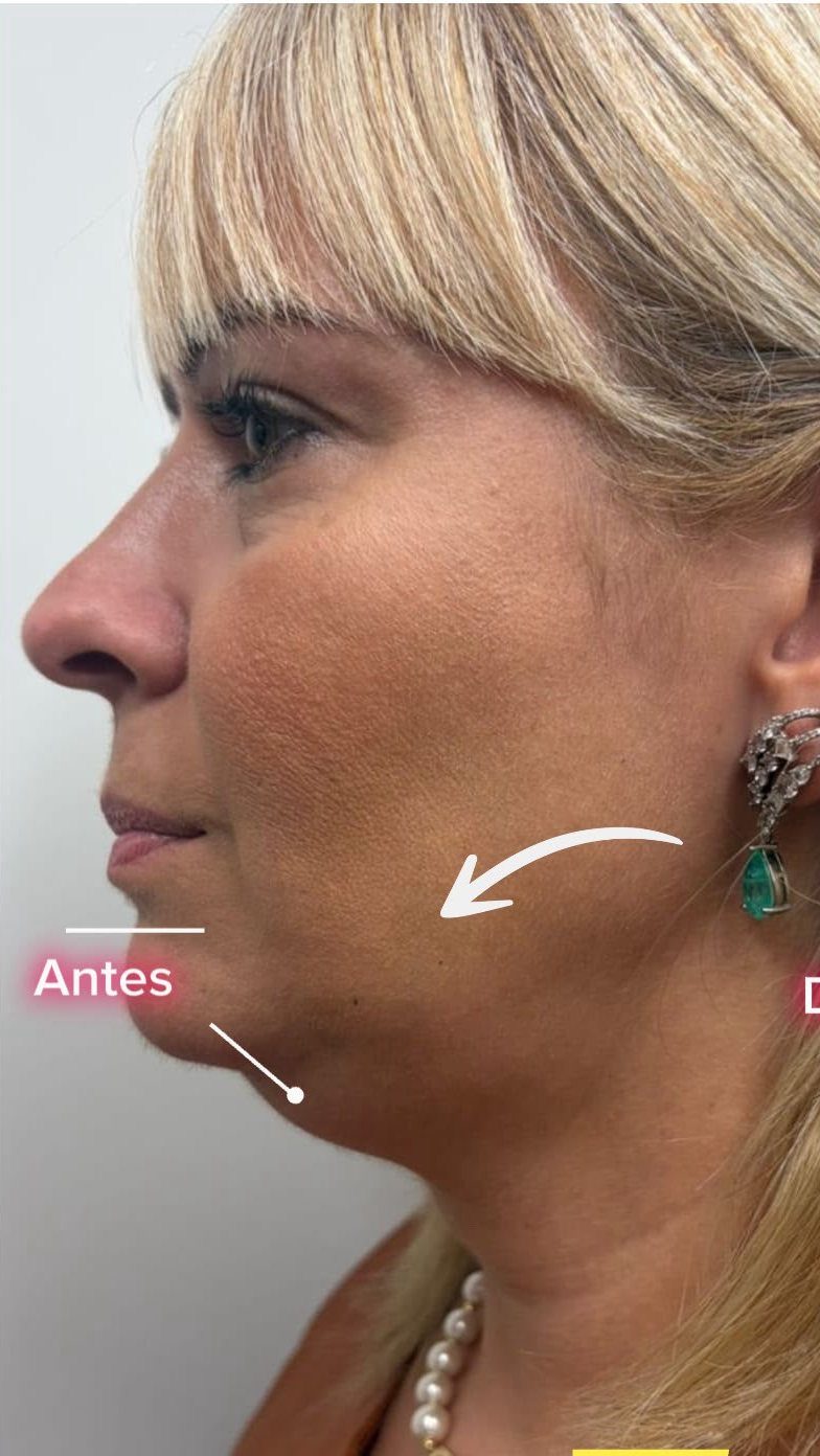Antes