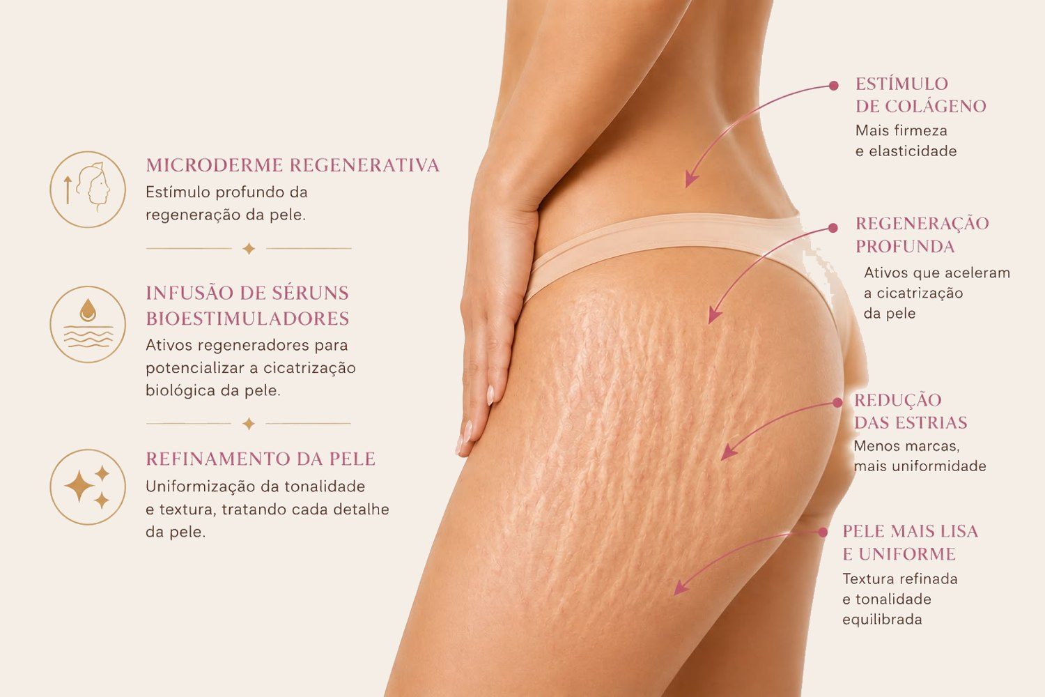 Tratamento de Estrias 4D
